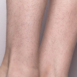 Before-Laser Hair Removal