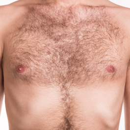 Before-Laser Hair Removal