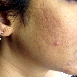 After-Microneedling