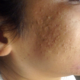 Before-Microneedling