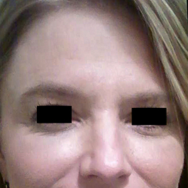 After-Microneedling