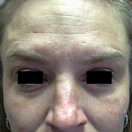 Before-Microneedling