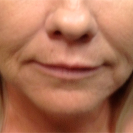 After-Microneedling
