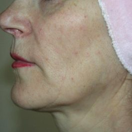 After-4 x Treatments