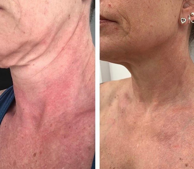 Radio Frequency Skin Tightening